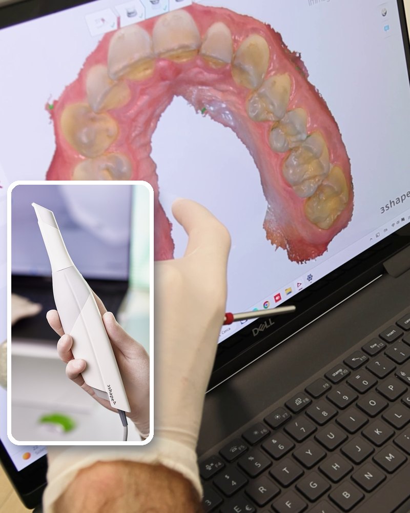 Scanner intraorale e impronta digitale in 3D